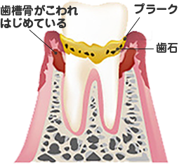 歯周病段階2期