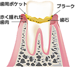 歯周病段階1期