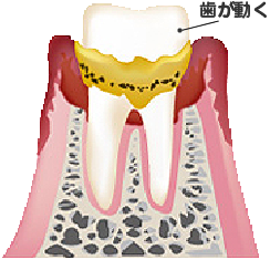 歯周病段階3期