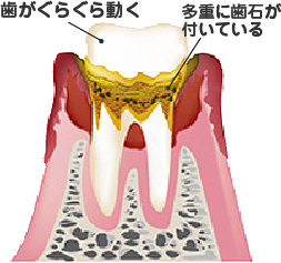 歯周病段階4期