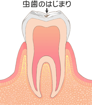 虫歯C0画像