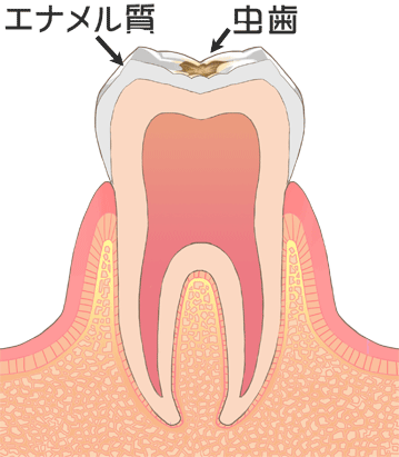虫歯C1画像
