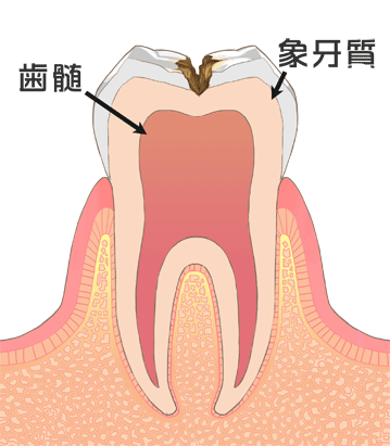 虫歯C2画像