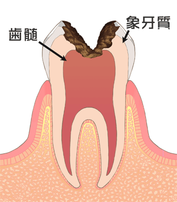 虫歯C3画像