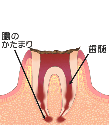 虫歯C4画像