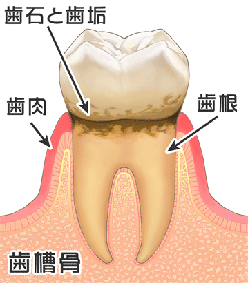 歯肉炎画像