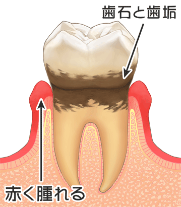 歯肉炎経度画像