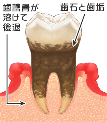 歯肉炎中等度画像